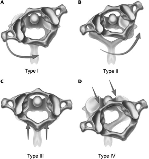 Fielding And Hawkins Classification Of Atlantoaxial Rotatory