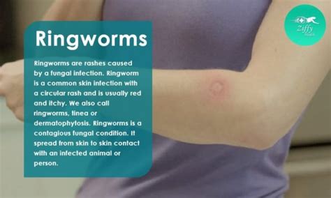 Blogsymptoms And Causes Of Ringworms