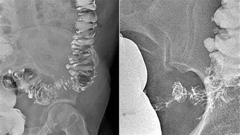 Сибр тонкого кишечника диета Дивертикулез Тонкого Кишечника Симптомы Лечение Диета — Похудение Диета Дивертикулез Тонкого Кишечника Симптомы Лечение Диета — Похудение Диета Сибр тонкого кишечника диета