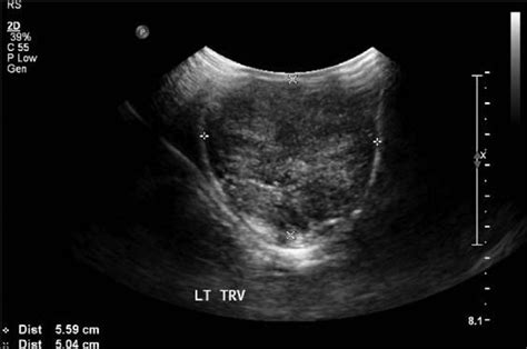 Testis Ultrasound Anatomy