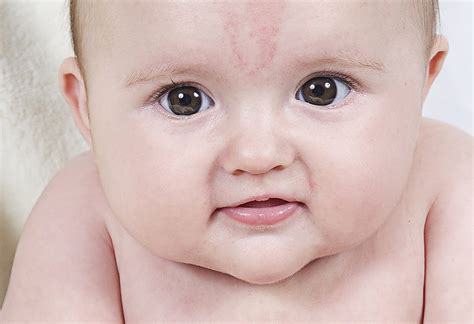 Birthmarks In Babies Types Causes And Treatment