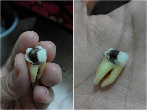 Penyebab utama dari terjadinya bengkak ini adalah karena seluruh bagian rahang serta saraf terjadi trauma. ! acuyuhan: Pengalaman Cabut Gigi Geraham