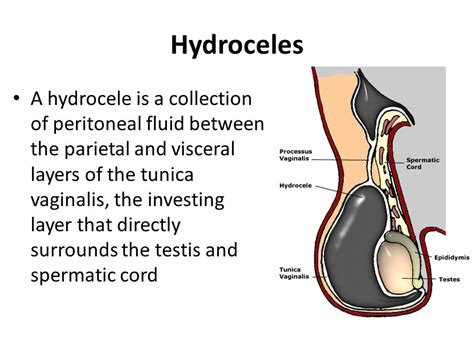 Hydrocele Symptoms Causes And Treatment Herbal Care Products