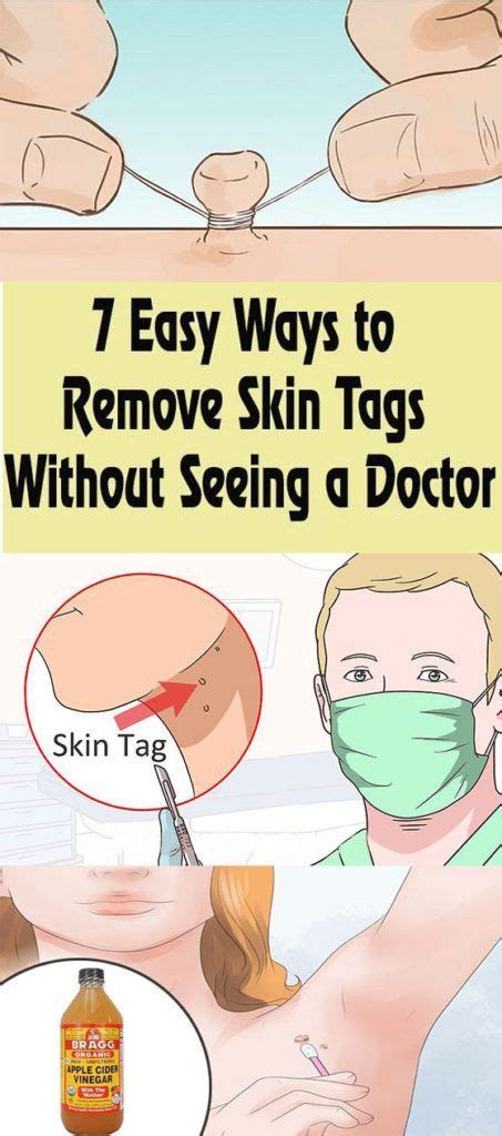 7 easy ways to remove skin tags without seeing a doctor home remedies for skin skin tag