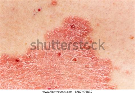 「detail Psoriatic Skin Disease Psoriasis Vulgaris」の写真素材（今すぐ編集） 1287404839