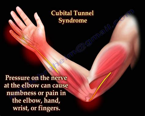 Cubital Tunnel Syndrome Ulnar Nerve Entrapment Everything You Need To