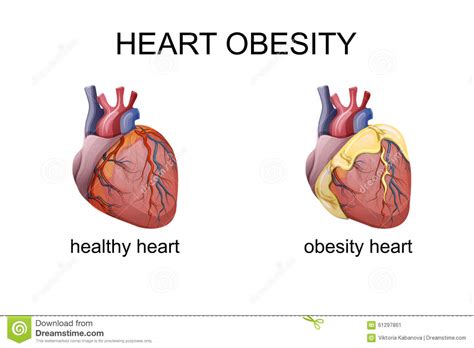 Adults 35 years of age and older with a bmi greater than 30 are obese. The Obesity Heart Stock Vector - Image: 61297861
