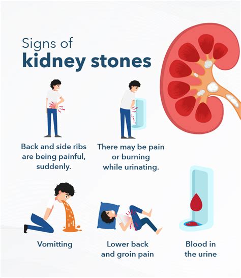 Behind The Pain The Warning Signs Of Kidney Stones Symptoms