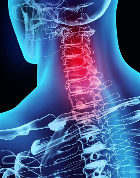 The Pinched Nerve And Pinched Nerve In Neck Are Treated At Joi