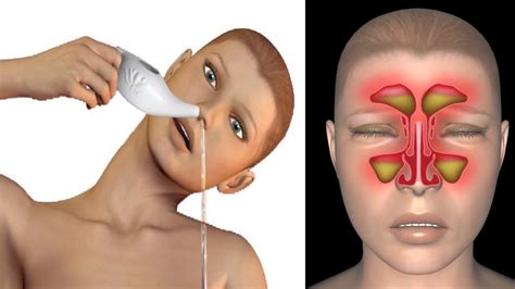 Powerful Natural Remedies To Relieve Sinus Pressure And Congestion In