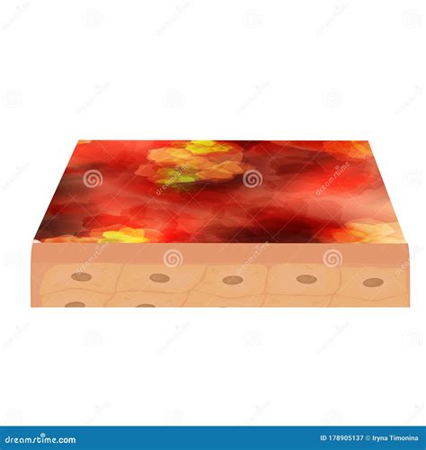 Cyst Acne. Acne On The Skin Of A Cyst. Dermatological And Cosmetic