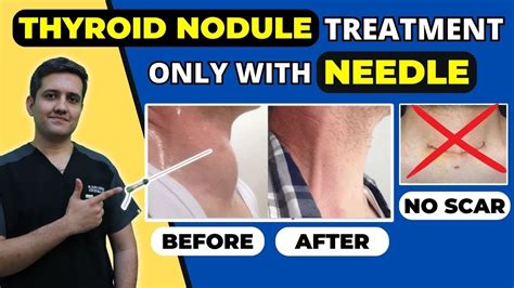 Thyroid Nodule Treatment Without Surgery Colloid Goiter Treatment