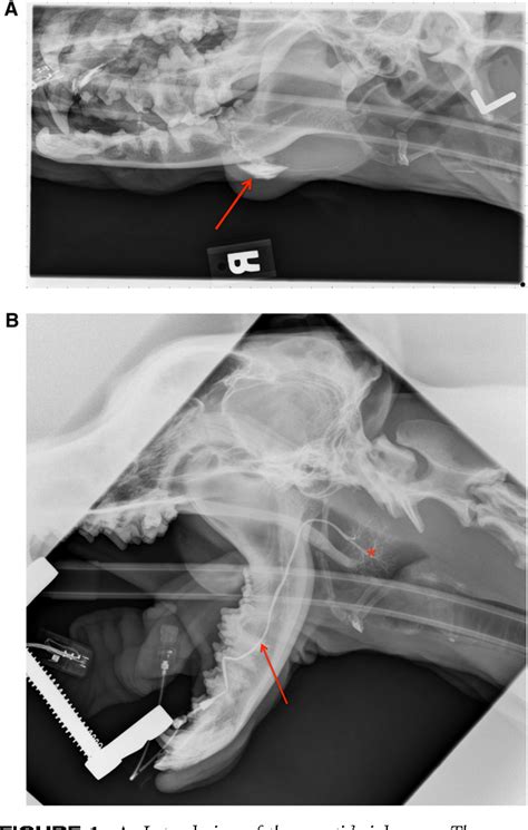 Figure 1 From Surgical Excision Of The Parotid Salivary Gland For
