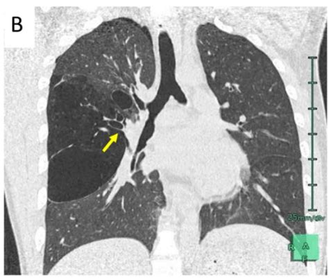 Bronchial Atresia In An Accessory Lobe Caused Tension Pneumothorax