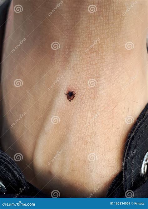 Tick With Its Head Sticking In Human Skin On A Leg The Tick Sucked