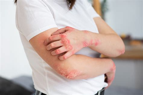 Dermatitis Atópica Síntomas Y Tratamientos Más Usuales