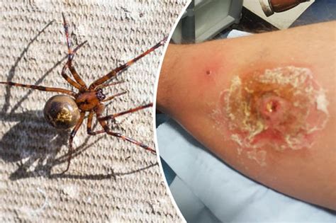 A protein venom is produced by the black widow spider and this venom affects the nervous system of the victim. False widow spider bite: British soldier left with hole in leg in horrific bite | Daily Star