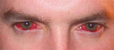 Deformutilation Subconjunctival Hemorrhages Part Iv