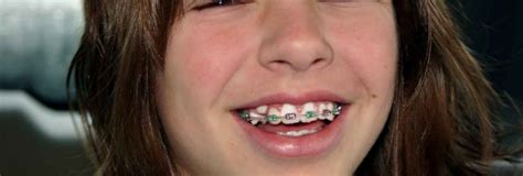 Braces For Kids Types Procedure Cost Orthodontist Hygiene