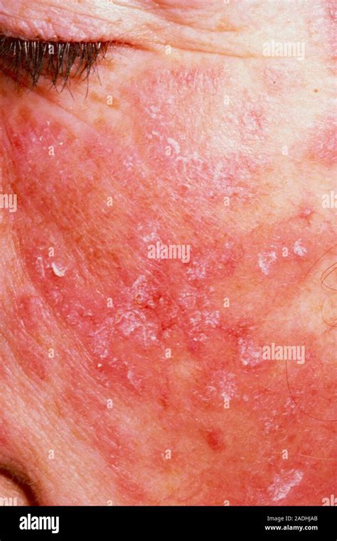 The Red Scaly Rash Of Systemic Lupus Erythematosus Sle Affecting A