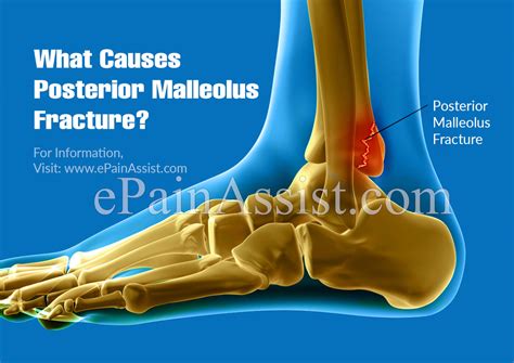 Posterior Malleolus Fracture: Causes, Symptoms, Diagnosis ...