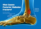 Posterior Malleolus Fracture: Causes, Symptoms, Diagnosis, Treatment ...
