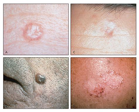 Examples Of Skin Cancer Types