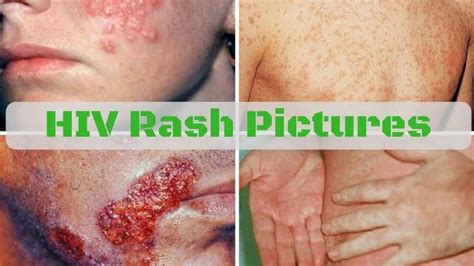 How To Identify Hiv Rashes On An Infected Person Expressive Info