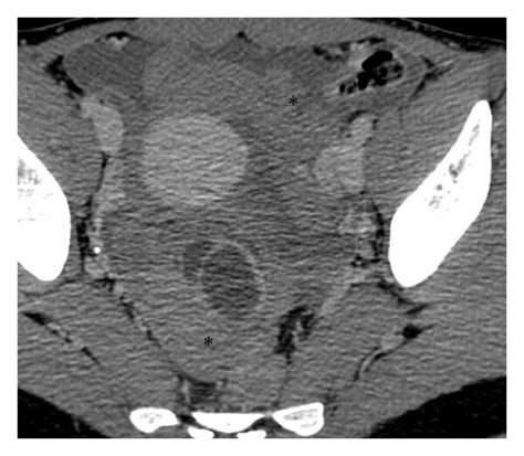 Dynamic Contrast Enhancement Ct Scan After Injection Of Contrast