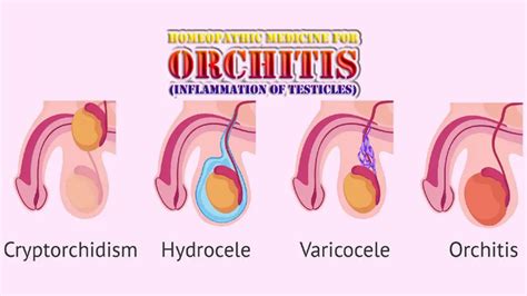 homeopathic medicine for orchitis inflammation of testicles homeopathic medicine 4 all disease