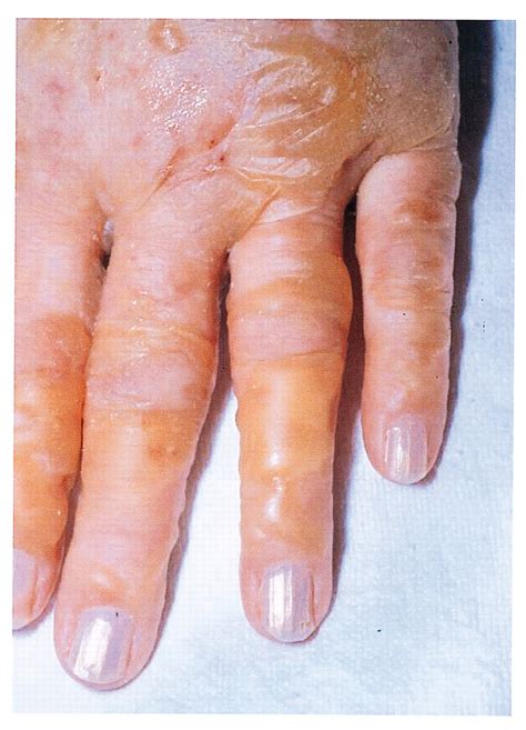 Linear Iga Bullous Dermatosis—bullous Lesions On The Hands Download