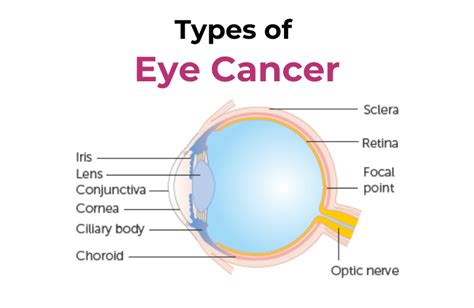 Eye Cancer Types Causes And Treatment Mmj Eye Hospital