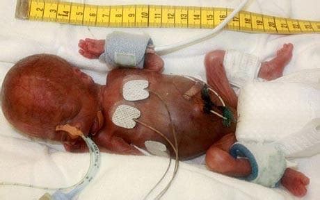 Convert the percentage to a fraction by placing the expression over 100. Premature baby 'Tom Thumb' born at 25 weeks weighing half ...