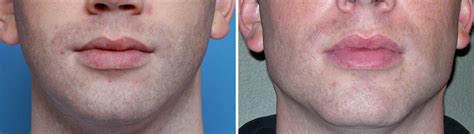 Plastic Surgery Case Study Three Piece Standard Chin And Jaw Angle