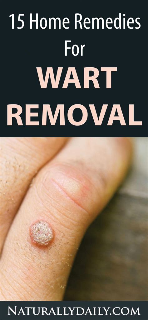 15 Home Remedies For Warts Easy Home Wart Treatments In 2020 Home