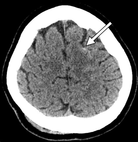 Traumatic Brain Injury Imaging Patterns And Complications Radiographics