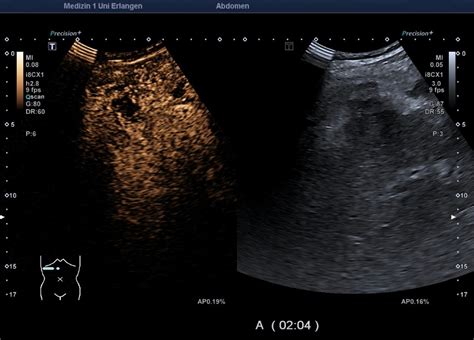 Gallbladder Perforation Atlas Of Ultrasound