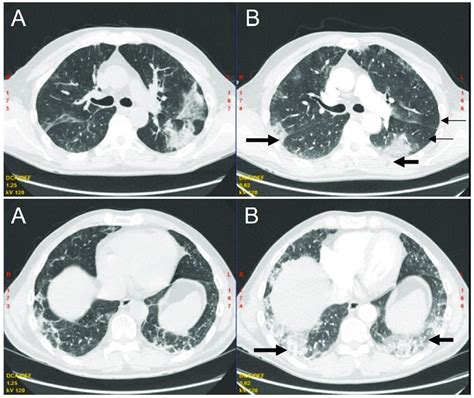 Initial Chest Ct A And One Month Follow Up Chest Ct B Axial Scans