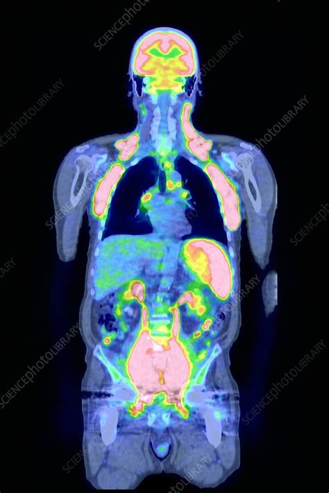 Non Hodgkins Lymphoma Ct And Pet Scans Stock Image C0017962