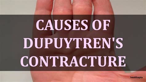 Causes Of Dupuytrens Contracture Youtube