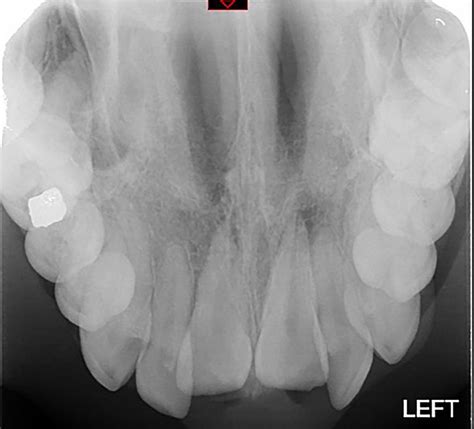 Management Of Severe Traumatic Intrusion In The Permanent Dentition