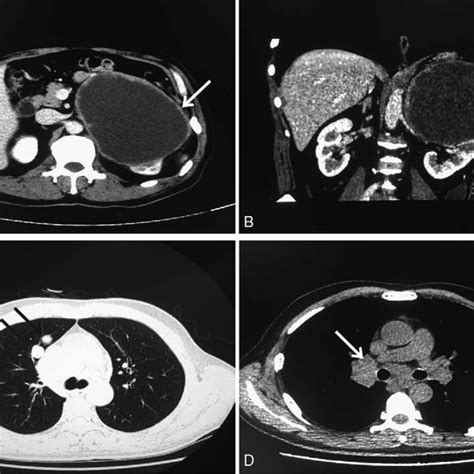 Abdominal Ct Scanned The Left Solid Abdominal Subcutaneous Mass And
