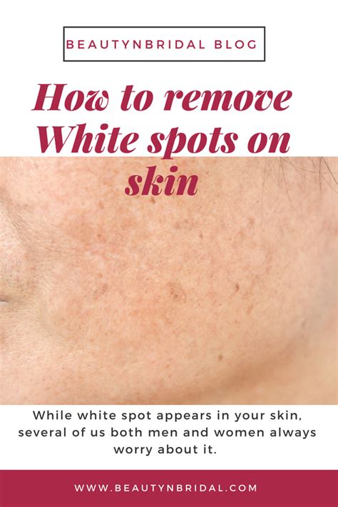 Studies have shown that people with vitiligo are often deficient in certain vitamins, like folic acid, b12, copper and zinc. What Is Treatment For White Spot On Skin By Ayurveda Quora
