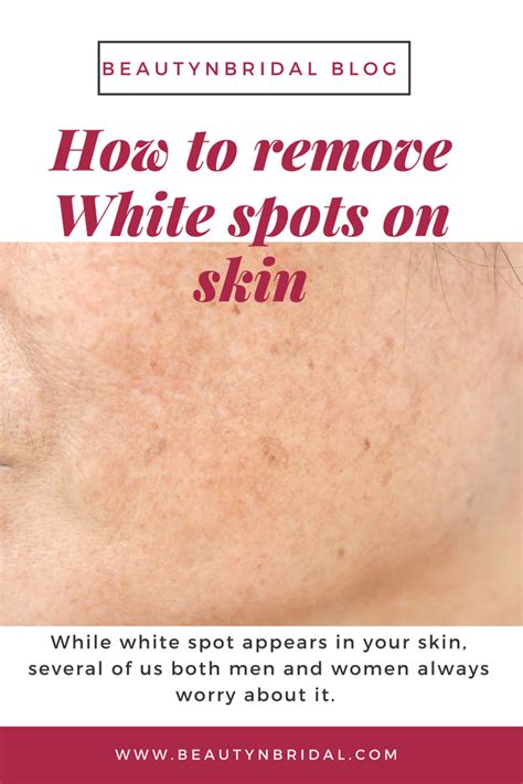 This is another very common reason behind the appearance of white patches on face of children. What is treatment for white spot on skin by Ayurveda? - Quora