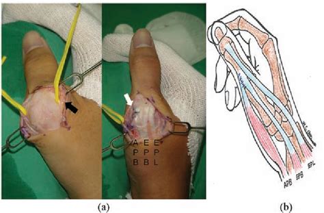 Figure 2 From Idiopathic Subluxation Of Extensor Pollicis Longus And