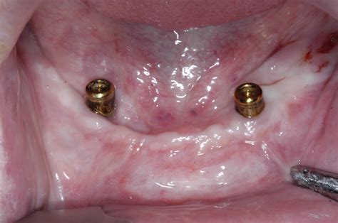 Dentures can still be removed even with mini dental implants. Dental Implants for Dentures | Dental Implants for ...