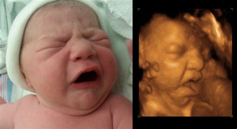 When involving a series of 3d volumes collected over time. 3D ultrasound, before and after pictures.