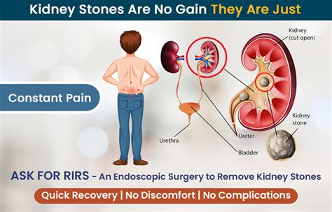 Kidney Stone Pain Location