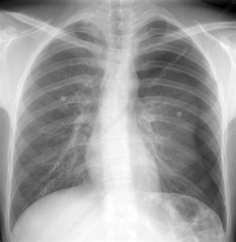 Collapsed Lung Frontal Chest X Ray Stock Image C048 6101 Science Photo Library