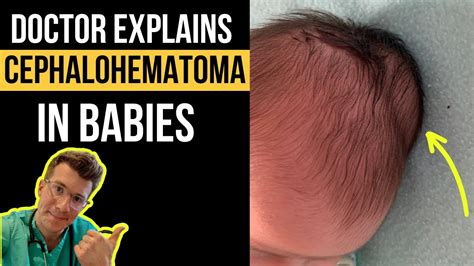 Doctor Explains Cephalohematoma In Babies Including Causes Pictures